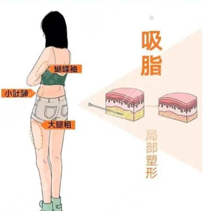 吸脂塑形