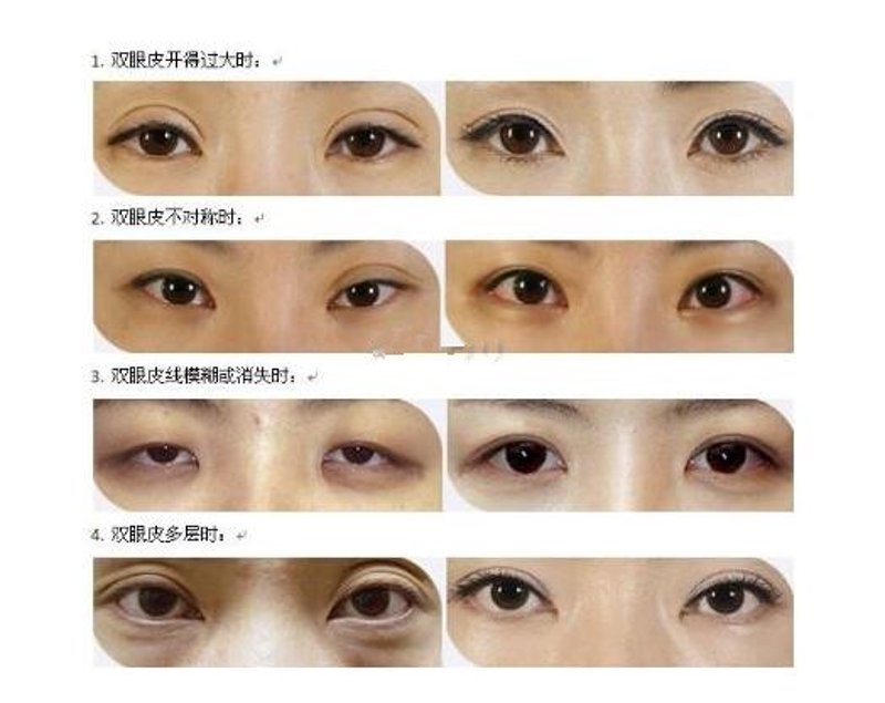 热玛吉技术在美容焕肤中的革新作用